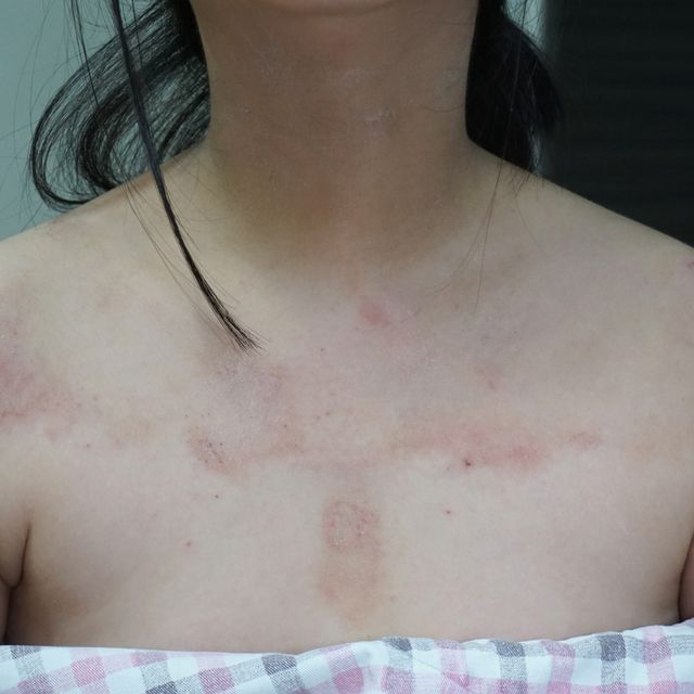 분당 아토피 치료 전 · 12세 여성