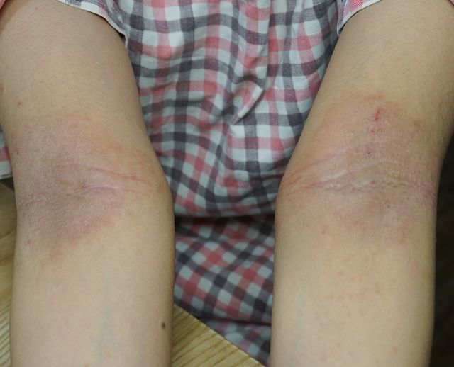 30세 여성 · 8개월 경과 · 치료 전