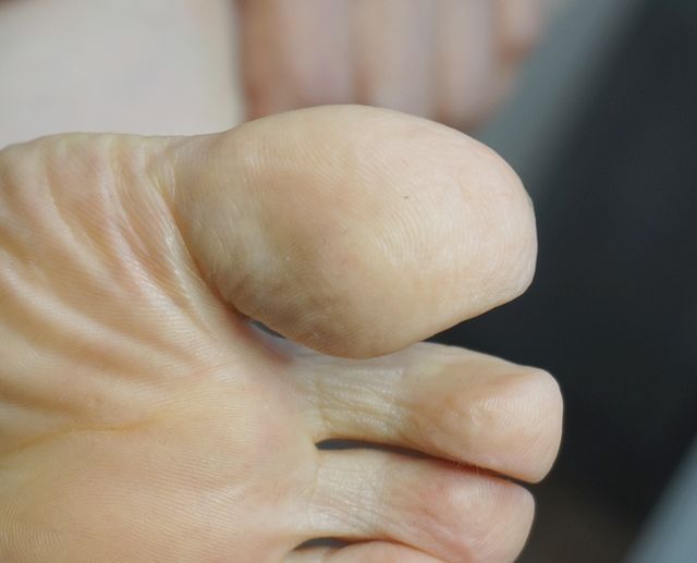 분당 한포진 치료 후 · 66세 여성 · 치료 기간 2개월