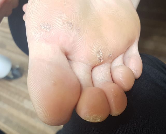 29세 여성 · 3개월 경과 · 치료 전