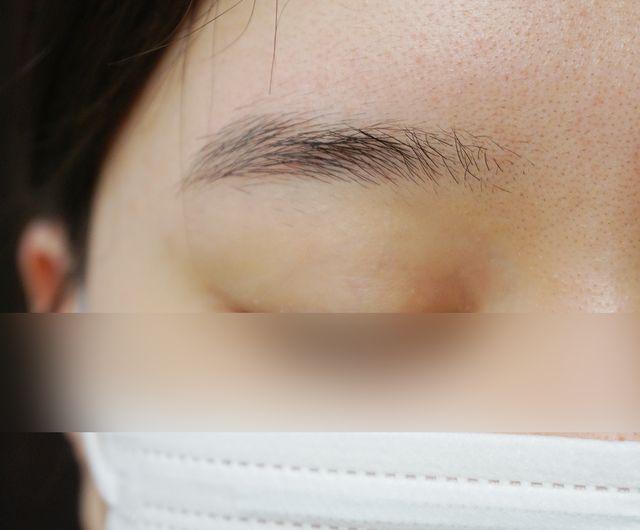 20세 여성 · 7개월 경과