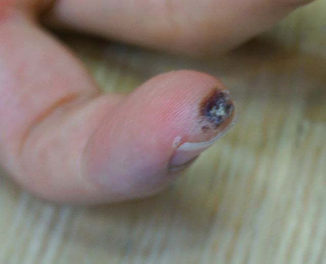 21세 남성 · 4개월 경과 · 치료 전