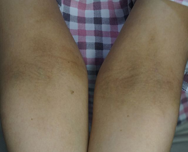 29세 여성 · 4개월 경과