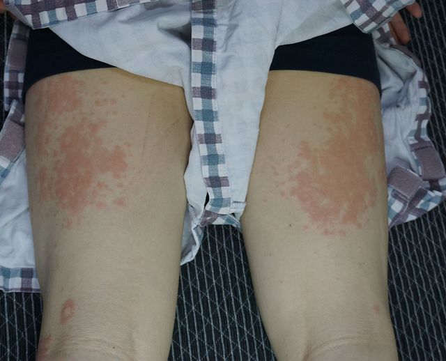 분당 두드러기 치료 전 · 23세 남성