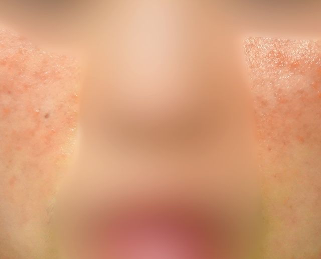 분당 지루성피부염 치료 전 · 32세 여성