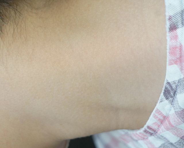 분당 두드러기 치료 후 · 8세 남성 · 치료 기간 10개월