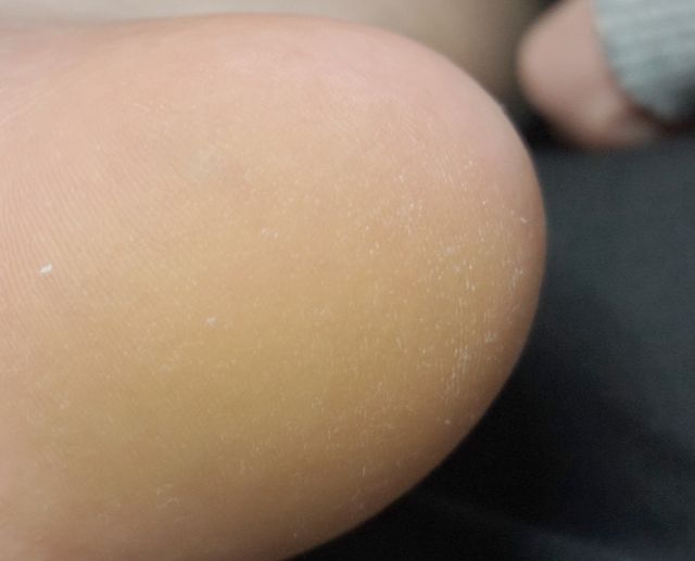 16세 여성 · 9개월 경과