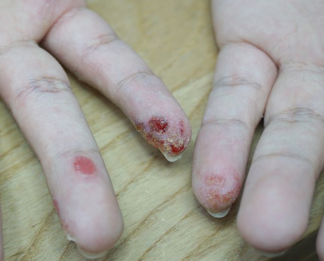 분당 아토피 치료 전 · 20세 남성